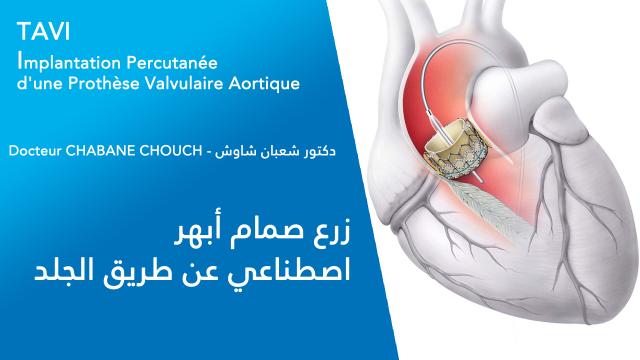 Le TAVI (Transcatheter Aortic Valve Implantation) 